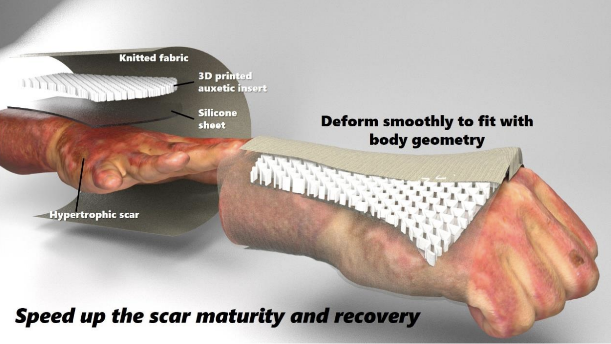 Finite Element Model for Design of Pressure Therapy Gloves for